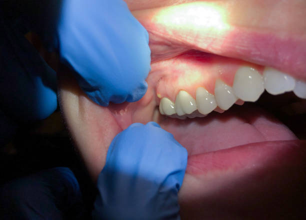 Best Emergency Wisdom Teeth Removal in Lincoln Center, KS